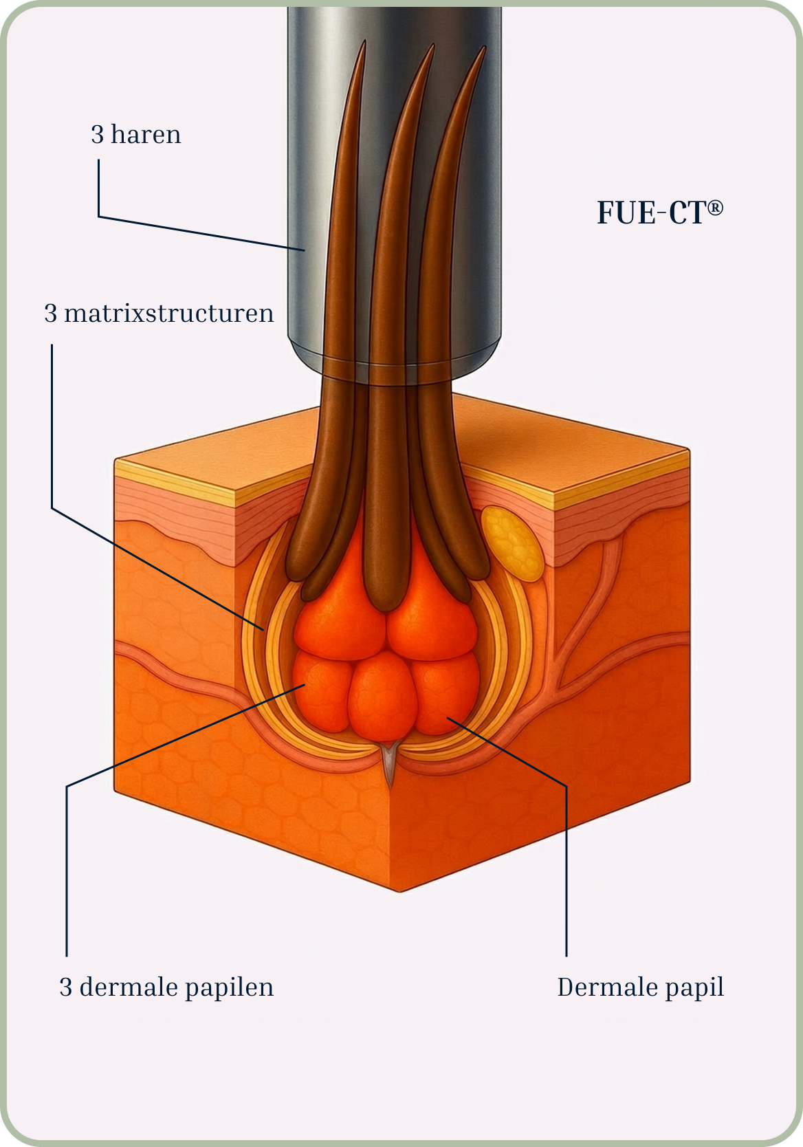 FUE CT extractie
